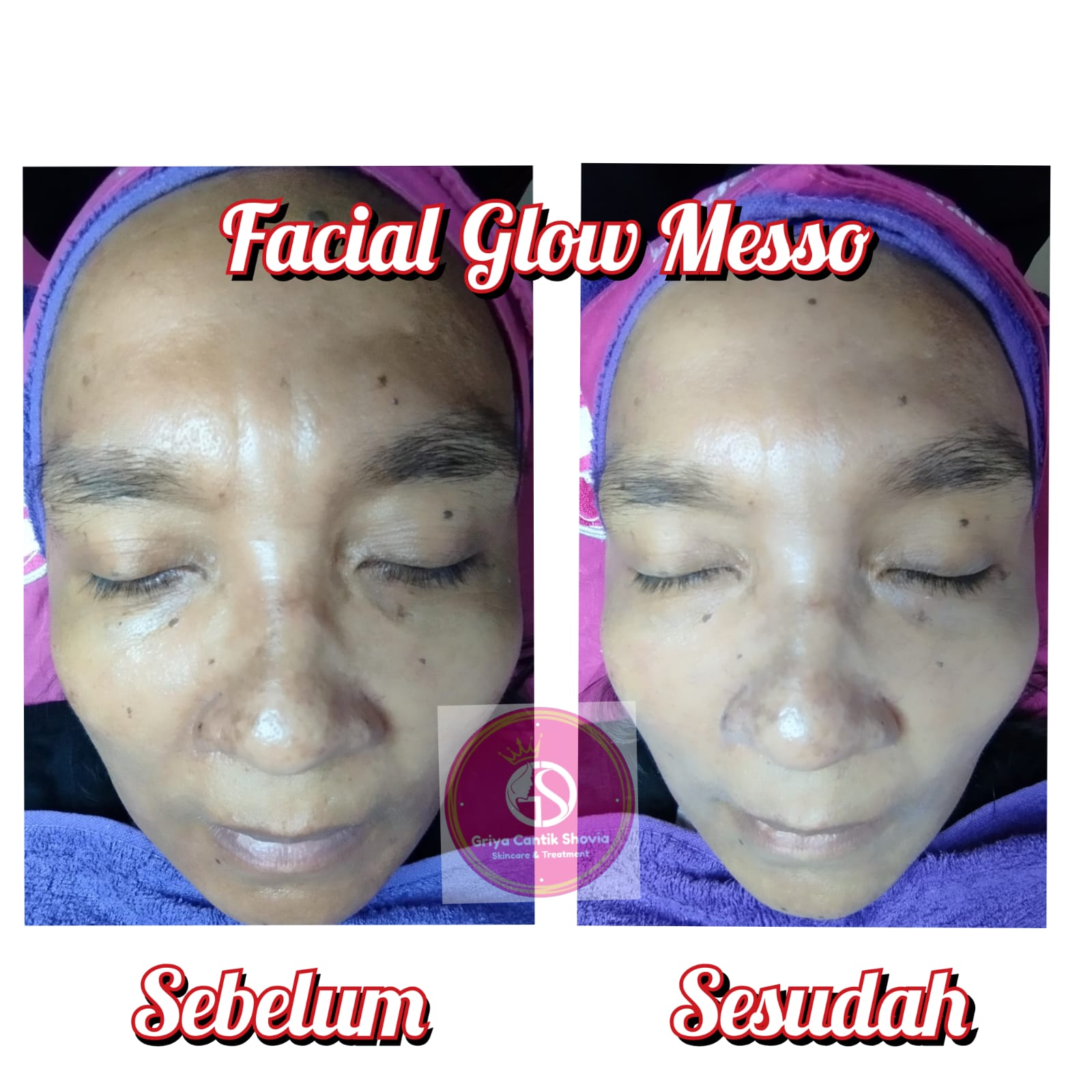 Testimoni Treatment 2 - DRW Skincare