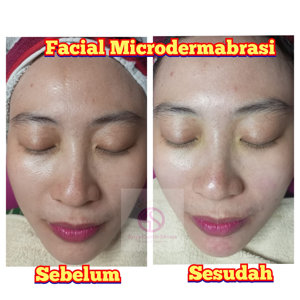 Testimoni Treatment 3 - DRW Skincare